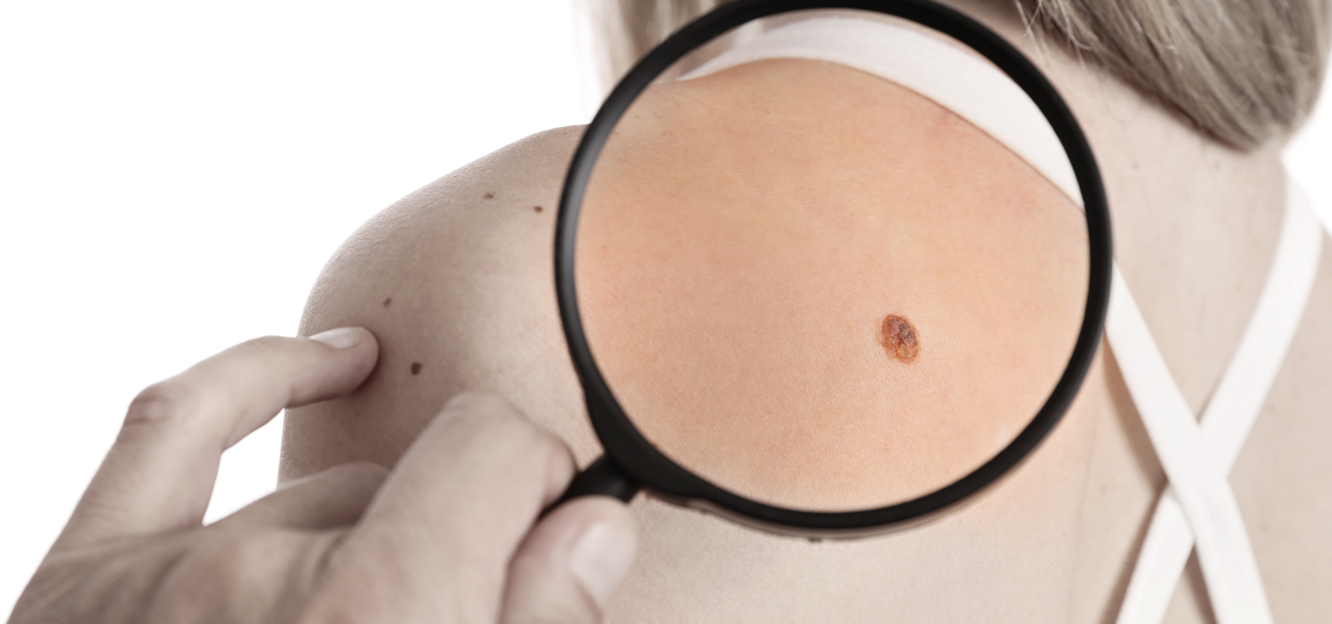Skin tag removal medicare Part B coverage